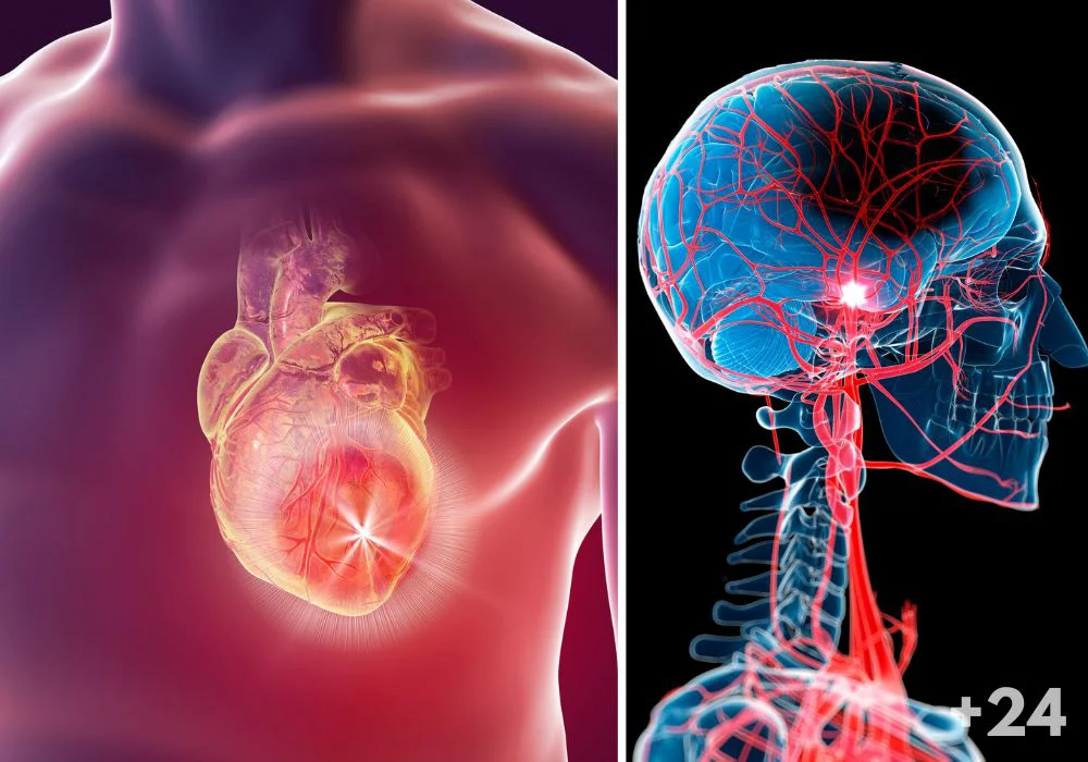 Cardiopatía isquémica y ACV
