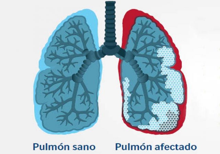 El Reto De Vivir Con Fibrosis Pulmonar Idiopatica