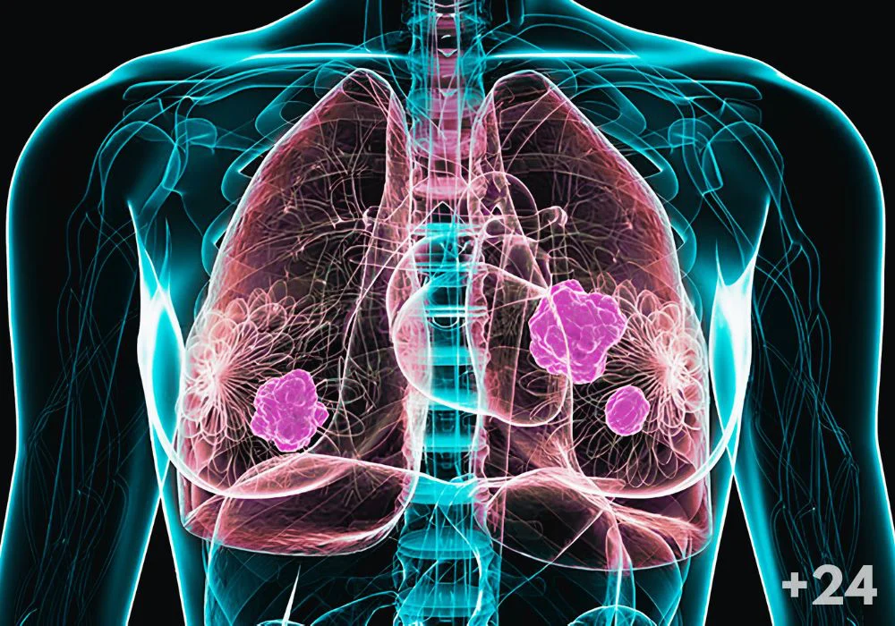 Enfermedades pulmonares